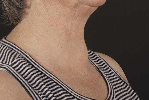 Patient photograph anterolateral view.