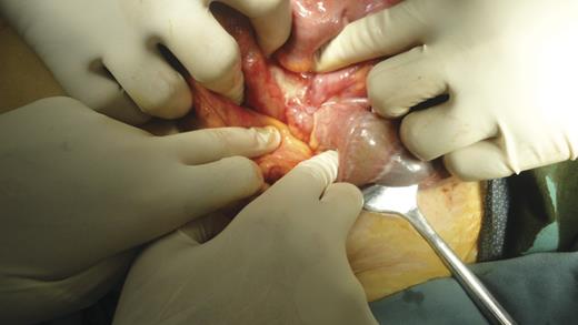 The tube of the gastric band encircles the appendix causing obstruction and infection of the lumen.