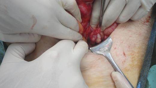 Removing the gastric band from the appendix.