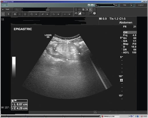 Ultrasound of the abdomen demonstrating a bowel related mass lesion in the epigastric region.