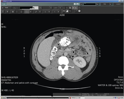 CT scan of abdomen showing the colo-colic intussusception.