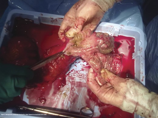 Intraoperative photograph showing the colonic lipoma in excised transverse colon.