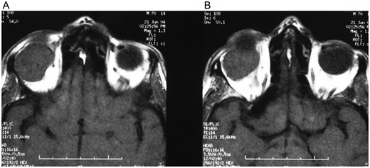 (A and B) Computerized tomography revealed a homogenously contrasted intraorbital mass in the right eye.