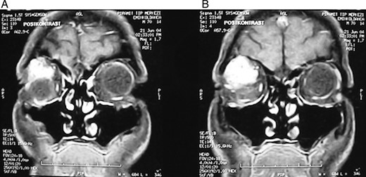 (A and B) Cranial MRI revealed a homogenously contrasted mass on the superolateral part of the right orbita.