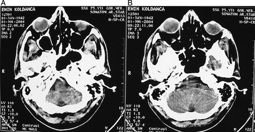 (A and B) Postoperative computerized tomography revealed the replacement of the eye.