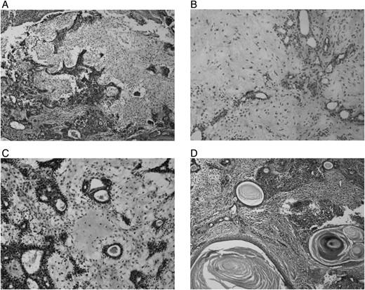 (A) Four times H-E biphasic tumor composed of epithelial and stromal components. (B) Ten times H-E fibromyxoid stroma and epithelium that form glandular structures. (C) Twenty times H-E cartilaginous focus in the stroma. (D) Four times H-E keratinized plugs in some glandular lumens.