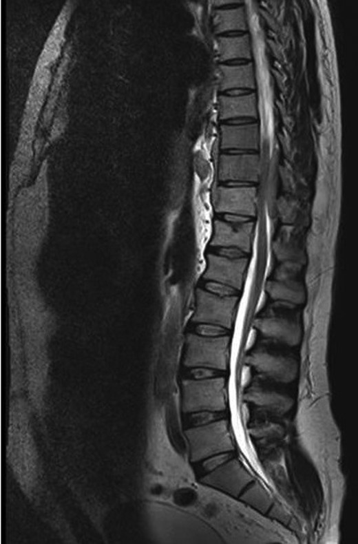 T2 weighted MRI revealed a mass at the T9-11 level.