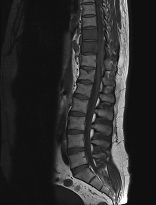 T1 weighted MRI revealed a mass at the T9-11 level.
