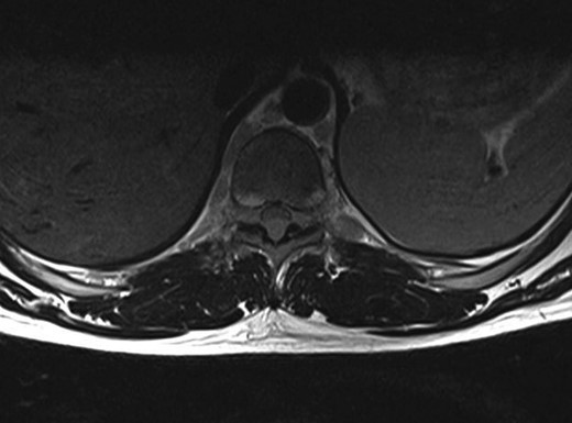 Axial T1 weighted MRI Revealed at the epidural space.