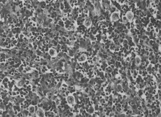 Histological examination revealed mixed cellularity type of Hodgkin's lymphoma.