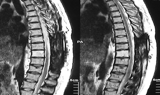 Postoperative MRI scan did not reveal any evidence of Hodgkin's disease.