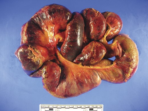 Hemorrhagic bowel with dark purple–black areas of gangrene and foci of serosal fibrinopurulent exudate.