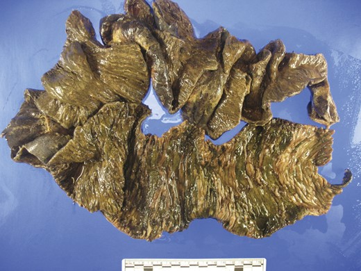 Admixed blood clot and fecal material, focally adherent to the granular, friable mucosa with associated exudate and edema.