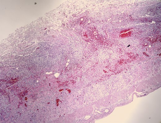 Transmural necrotic, hemorrhagic and congested bowel wall.