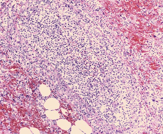 Mononuclear cells associated with scattered neutrophils and prominent fungal hyphae in subserosal arteries and invading vessel walls.