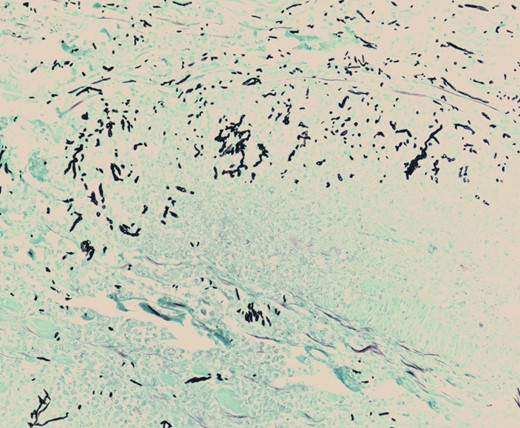 Gomori Methenamine Silver stain highlighting fungal forms, some dichotomous, with frequent septation, characteristic of Aspergillus species.