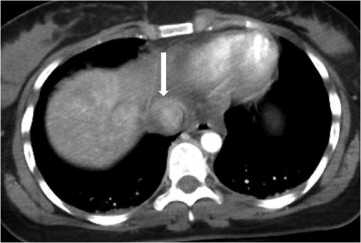 Axial contrast-enhanced CT of the chest showing abnormal contour of the supradiaphragmatic IVC with ventrally and laterally confined contrast extravasation (arrow) consistent with a pseudoaneurysm surrounded by pericaval hematoma.