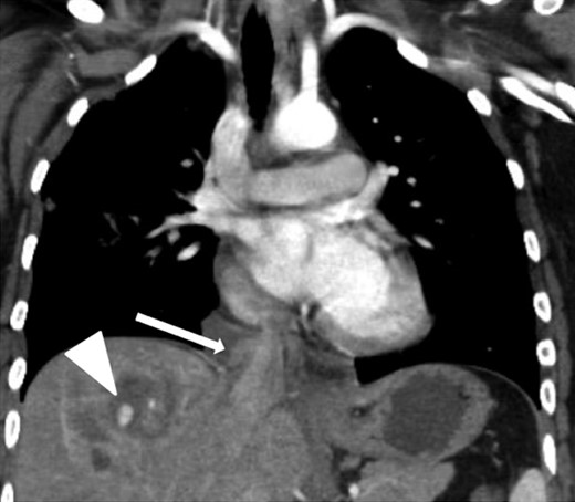 Coronal contrast-enhanced CT of the chest showing abnormal contour of the supradiaphragmatic IVC with ventrally and laterally confined contrast extravasation (arrow) consistent with a pseudoaneurysm surrounded by pericaval hematoma as well as a segment 8 hepatic hypodensity consistent with liver laceration and focal area of contrast extravasation (arrowhead).