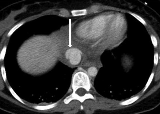Axial contrast-enhanced CT of the abdomen performed 30 min after the initial CT of the chest showing persistence of the abnormal contour of the supradiaphragmatic IVC with contrast extravasation confined laterally and ventrally (arrow), nonexpanding pericaval hematoma.