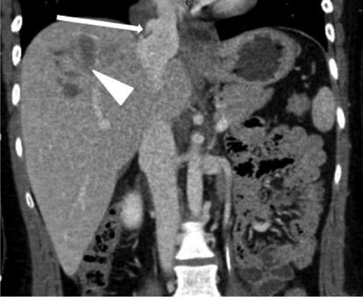 Coronal contrast-enhanced CT of the abdomen performed 30 min after the initial CT of the chest showing persistence of the abnormal contour of the supradiaphragmatic IVC with contrast extravasation confined laterally and ventrally (arrow), nonexpanding pericaval hematoma and a segment 8 hypodensity (arrowhead) consistent with liver laceration.