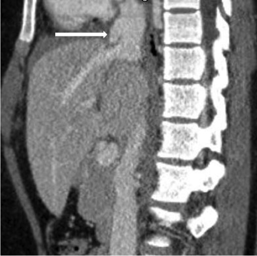 Sagittal contrast-enhanced CT of the abdomen performed 30 min after the initial CT of the chest showing persistence of the abnormal contour of the supradiaphragmatic IVC with contrast extravasation confined laterally and ventrally (arrow), nonexpanding pericaval hematoma.