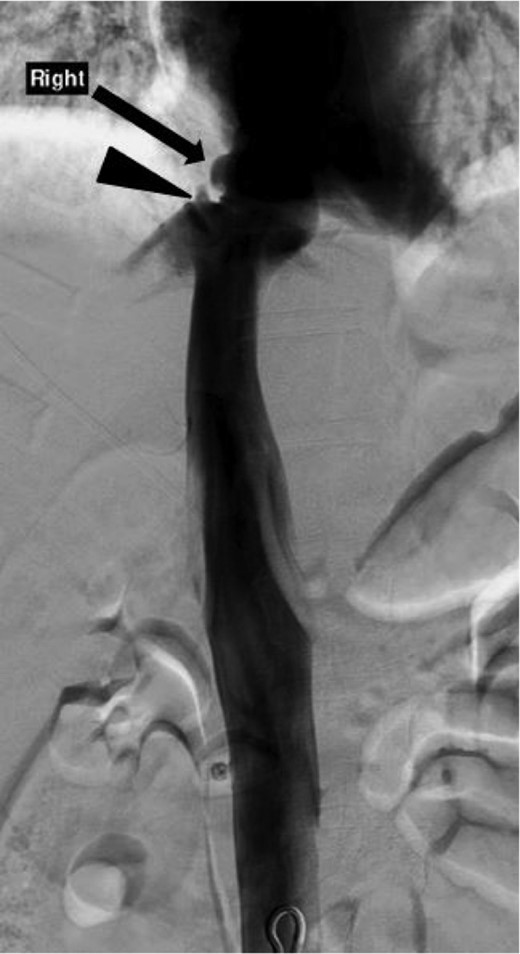 Inferior venacavagram showing a mild contour irregularity of the suprahepatic IVC without contrast extravasation (arrow) and a slight contour irregularity of the middle hepatic vein without contrast extravasation (arrowhead) consistent with a pseudoaneurysm of the IVC and right middle hepatic vein.