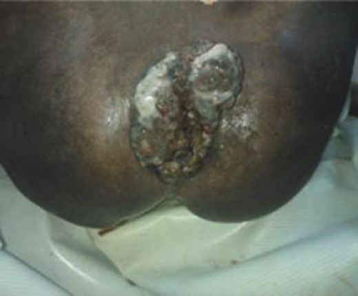 Prolapsed thrombosed fourth degree haemorrhoids (with permission).