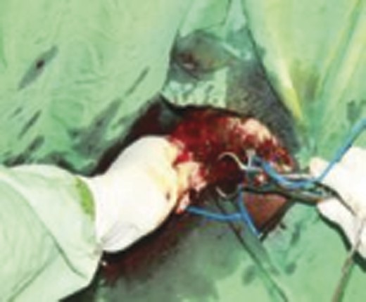 Milligan–Morgan haemorrhoidectomy.