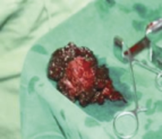 Conglomeration of clots in external components.