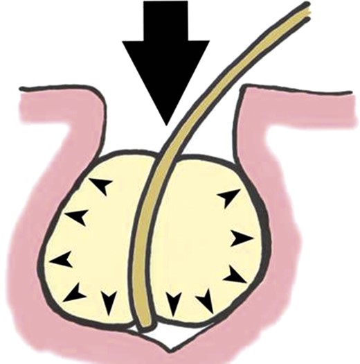 Schematic diagram showing transference of external pressure by balloon (A) to the internal aspect of a wound (B).