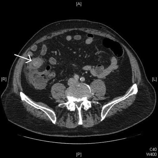 CT scan demonstrating a stone within an area of bowel.