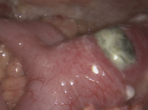 Intraoperative picture demonstrating the gallstone entrapped in the MD.