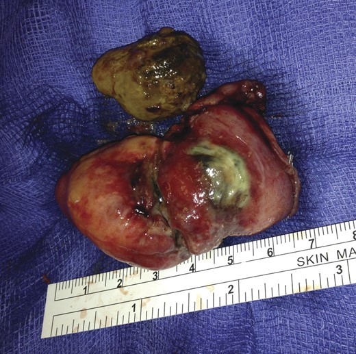 Gallstone removed from MD extra corporally and inspected.