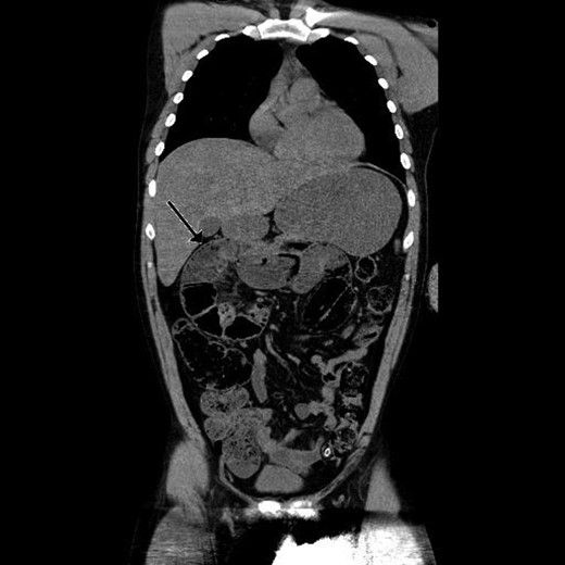Coronal view of preoperative abdominal CT scan demonstrating encapsulated dilated small intestines in the right upper quadrant with pneumatosis intestinalis.