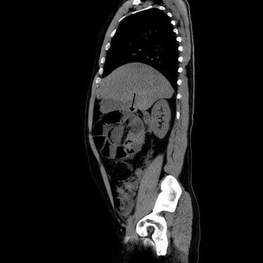 Sagittal view of preoperative abdominal CT scan demonstrating encapsulated dilated small intestines in the right upper quadrant with pneumatosis intestinalis.