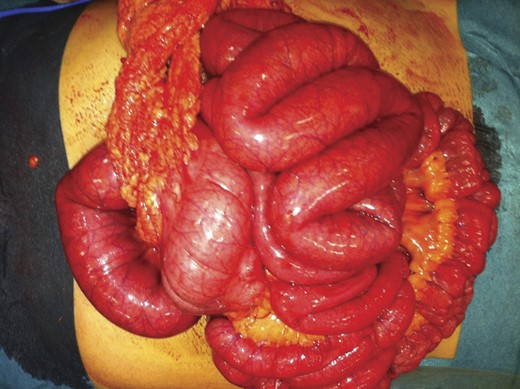Intra-operative picture of distended but vital small bowel.