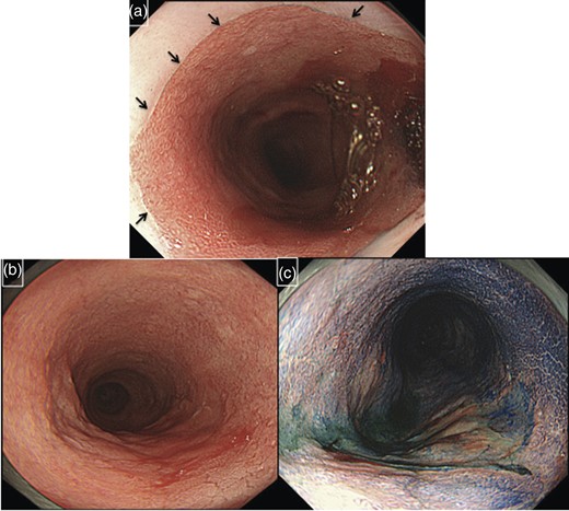 Endoscopic examination of the patient. The oral margin of Barrett's esophagus was 17 cm from the incisors (black arrows indicate the margin of Barrett's epithelium) (a). Ulceration was found 27–31 cm from the incisors (b and c). Pathological diagnosis was adenocarcinoma with Barrett's esophagus.