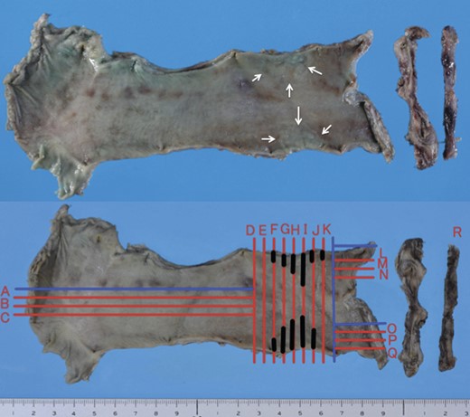 Macroscopic findings of resected esophagus and jejunum. Irregular mucosa of the upper esophagus was accidentally cut into two pieces (arrowheads) (upper side). Black lines (F, G, H, I, J and K) indicate the areas of carcinoma.