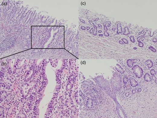 Postoperative pathological examination. A well-differentiated adenocarcinoma was revealed in Barrett's esophagus (a and b). Microsquamous epithelial islands remained in Barrett's epithelium (c and d).