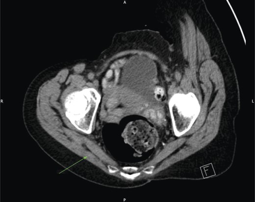 CT of the patient's pelvis demonstrating a normal right sciatic foramen (arrowed).