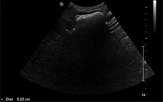 Ultrasound image demonstrating the sciatic hernia. (Reported as ‘US Hip Rt: Confirms reducible herniation of colon in the right sciatic region into the buttock.’)