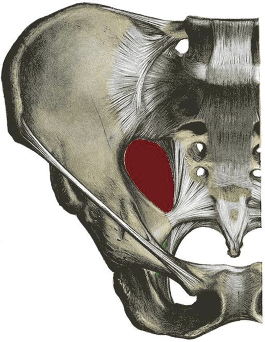 Pelvis demonstrating the greater (red) and lesser (green) sciatic foraminae.