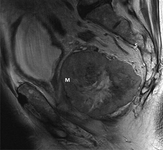 T2-weighted sagittal image demonstrating a large mass (m) anterior to the sacrum (S) and posterior to the bladder.