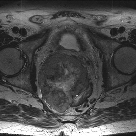 T2-weighted axial showing the same mass lying adjacent to the anterior wall of the rectum (*).