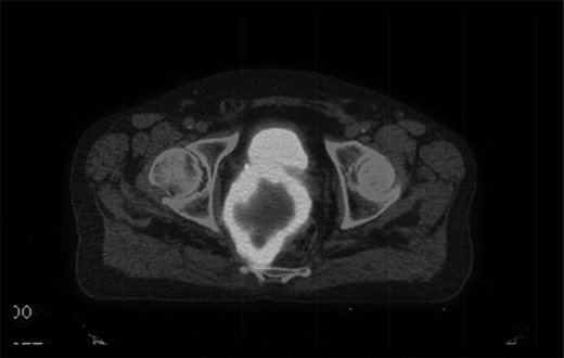 Axial fused PET-CT image pre-treatment, demonstrating that the mass has avid peripheral tracer uptake and a hypometabolic, tracer inavid centre.