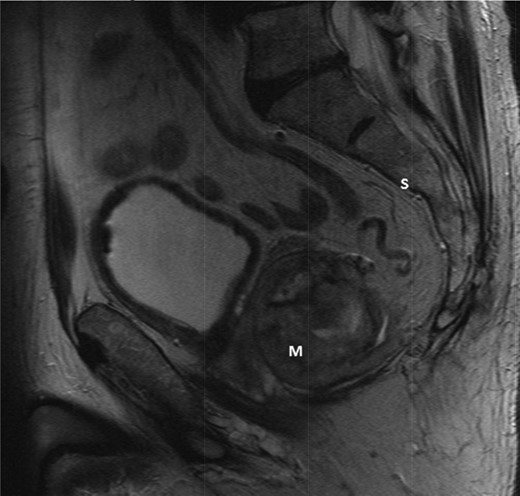 T2-weighted sagittal images after 3 months of imatinib mesylate therapy. The mass has shown a significant reduction in size (Mass = m, Sacrum = s).