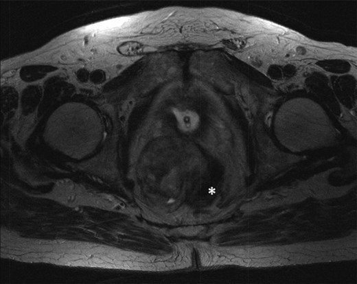 T2-weighted axial images after 3 months of imatinib mesylate therapy. The mass has shown a significant reduction in size (white star).