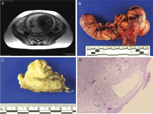 Radiographic and pathologic findings of appendicular endometriosis presenting as acute appendicitis in a gravid patient. (A) Abdominal MRI showing an enlarged appendix with intraluminal hypodensities representing ectopic endometrial tissue and periappendiceal inflammatory changes (arrow) in a gravid patient. (B) Gross pathology of distal ileum, cecum and adherent appendix. The appendix is encased in fibrous adhesions and hemorrhage marking the extent of the inflammatory process. The cecum has a perforation in the region of the appendiceal base (C) Formalin-fixed ileum and appendix. The light yellow area illustrates ectopic endometrial tissue. (D) Histology of the resected appendix depicts transmural intestinal endometriosis with extensive decidualization. This interpretation was supported by immunostains for CD68 and cytokeratin AE1/AE3 (not shown).