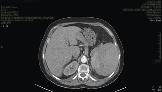CT chest/abdomen demonstrating a large splenic haematoma with hyper- and hypo-dense areas. High attenuation fluid is present within the pelvis consistent with blood.