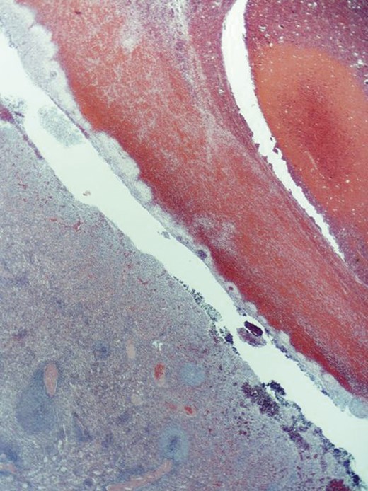 ×5 HE. Capsular haematoma with rupture.